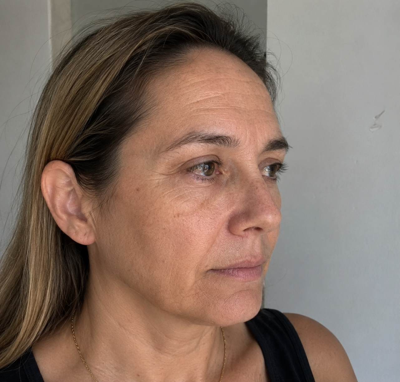 Sin Botox